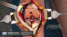 Tibial Stem