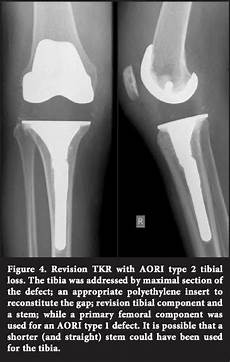 Tibial Stem