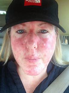 Topical Cream
