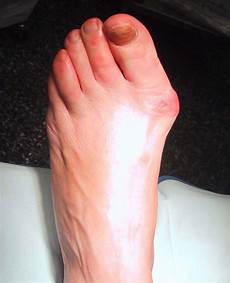 Valgus Splints