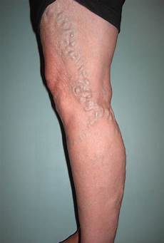 Varicose Stockings