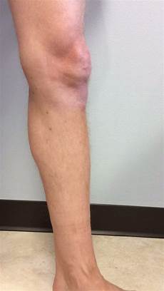 Varicose Stockings