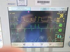 Ventilator