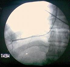 Vertebroplasty System